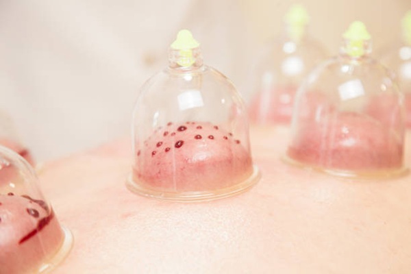 Hijama, wet cupping therapy. Wet cupping involve suction and controlled medicinal bleeding. Sensitive content. Images of real medicinal treatment with blood. Vacuuming glass cups and bleeding inside.