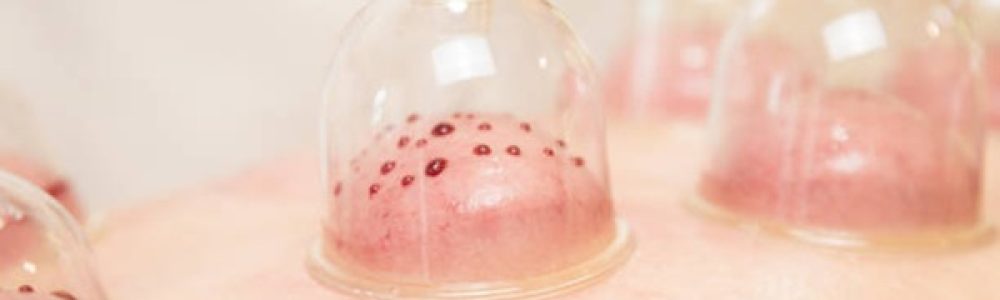 Hijama, wet cupping therapy. Wet cupping involve suction and controlled medicinal bleeding. Sensitive content. Images of real medicinal treatment with blood. Vacuuming glass cups and bleeding inside.
