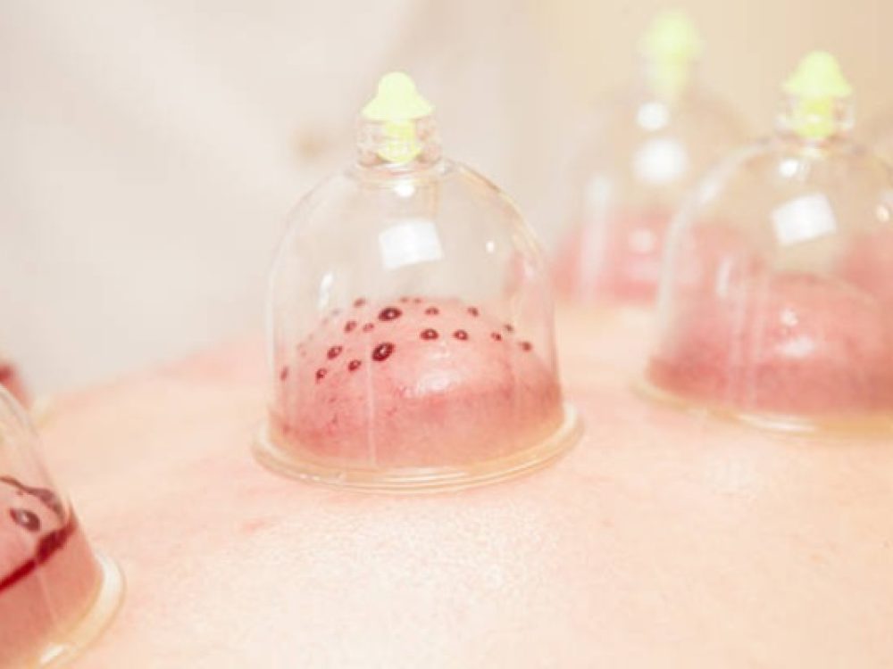 Hijama, wet cupping therapy. Wet cupping involve suction and controlled medicinal bleeding. Sensitive content. Images of real medicinal treatment with blood. Vacuuming glass cups and bleeding inside.